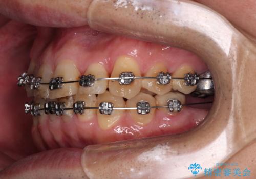 激痛の奥歯のむし歯治療 折角なので矯正治療もしたいの治療中