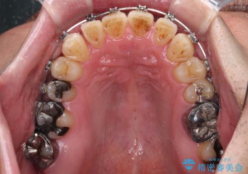 激痛の奥歯のむし歯治療 折角なので矯正治療もしたいの治療中