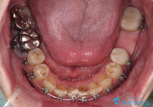 激痛の奥歯のむし歯治療 折角なので矯正治療もしたいの治療中