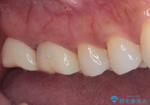 歯周外科処置を併用した奥歯のむし歯治療の治療前