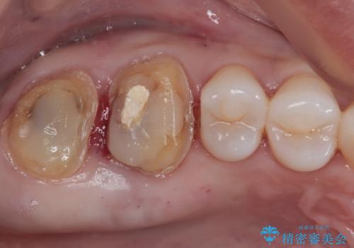 歯周外科処置を併用した奥歯のむし歯治療の治療前
