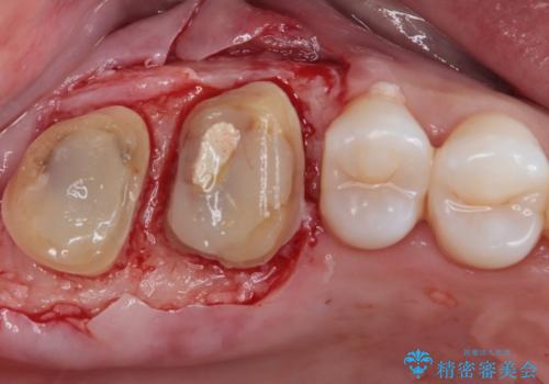 歯周外科処置を併用した奥歯のむし歯治療の治療中