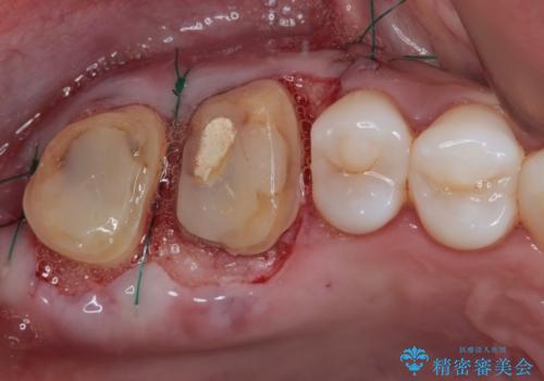 歯周外科処置を併用した奥歯のむし歯治療の治療中