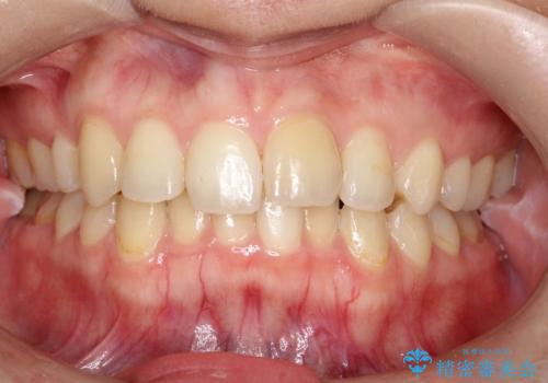 矯正後の後戻り インビザラインで改善の治療前
