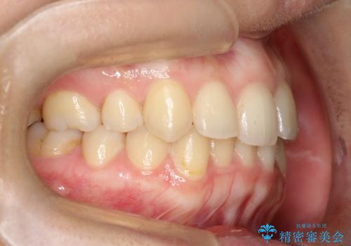 矯正後の後戻り インビザラインで改善の治療前