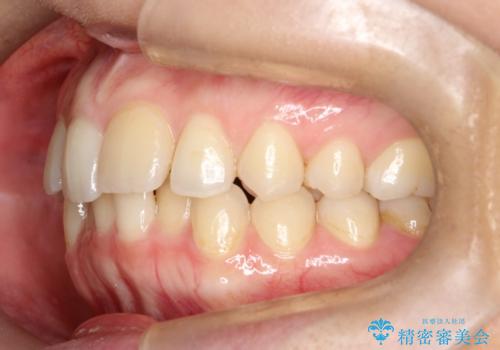 矯正後の後戻り インビザラインで改善の治療前