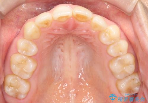 矯正後の後戻り インビザラインで改善の治療前