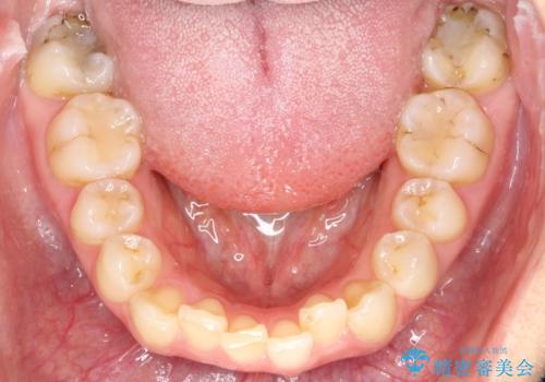 矯正後の後戻り インビザラインで改善の治療前