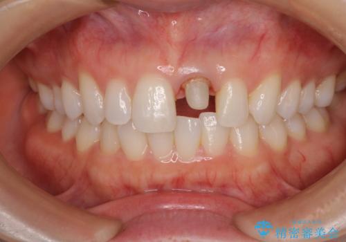 外れやすい前歯をどうにかしたい。の治療中