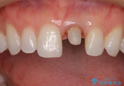 外れやすい前歯をどうにかしたい。の治療中
