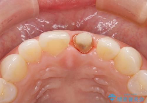 外れやすい前歯をどうにかしたい。の治療中