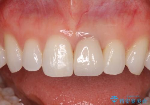 外れやすい前歯をどうにかしたい。の治療後