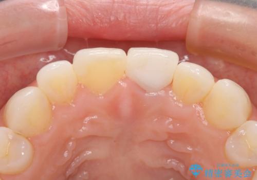 外れやすい前歯をどうにかしたい。の治療後
