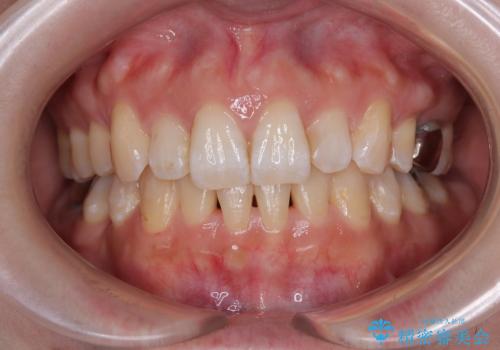 目立たない裏側装置でデコボコをきれいに解消の治療後