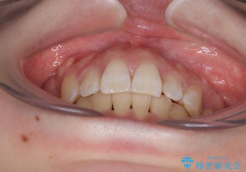 目立たない裏側装置でデコボコをきれいに解消の治療後