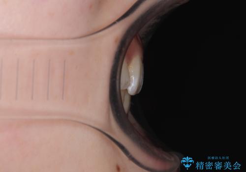 目立たない裏側装置でデコボコをきれいに解消の治療後