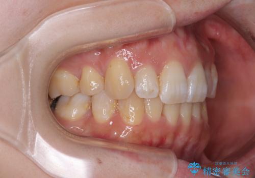 目立たない裏側装置でデコボコをきれいに解消の治療後