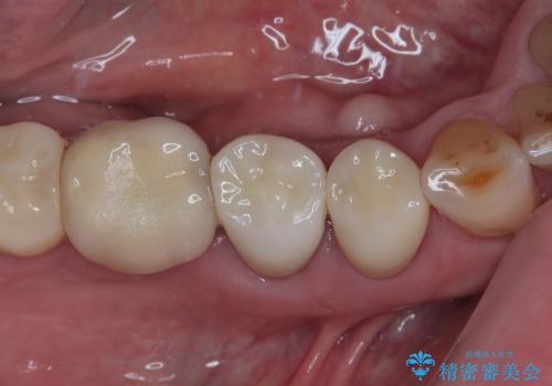 咬合力で欠けてしまった歯 丈夫なセラミッククラウンでの補綴治療の症例 治療後