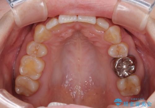 目立たない裏側装置でデコボコをきれいに解消の治療後