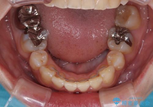 目立たない裏側装置でデコボコをきれいに解消の治療後