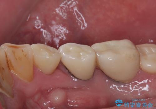 咬合力で欠けてしまった歯 丈夫なセラミッククラウンでの補綴治療の治療後