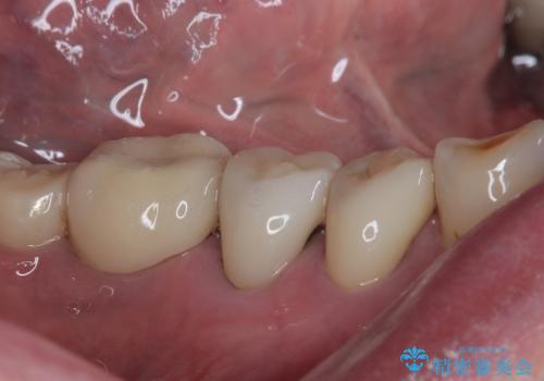 咬合力で欠けてしまった歯 丈夫なセラミッククラウンでの補綴治療の治療後