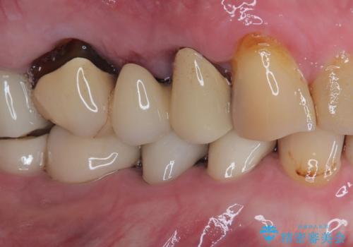 咬合力で欠けてしまった歯 丈夫なセラミッククラウンでの補綴治療の治療後
