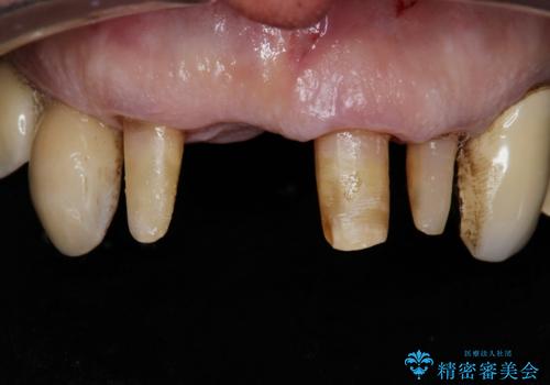 前歯がグラグラする。の治療中