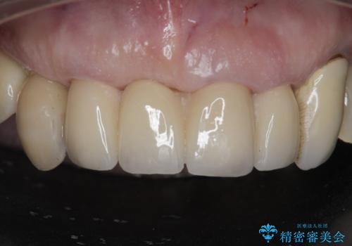前歯がグラグラする。の症例 治療後