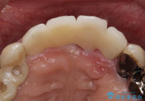 前歯がグラグラする。の治療後