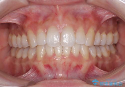 補助装置を用いて奥歯の咬み合わせを事前に改善　インビザラインによる矯正治療の症例 治療後