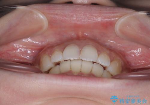 補助装置を用いて奥歯の咬み合わせを事前に改善 インビザラインによる矯正治療の治療後