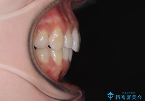 補助装置を用いて奥歯の咬み合わせを事前に改善 インビザラインによる矯正治療の治療後