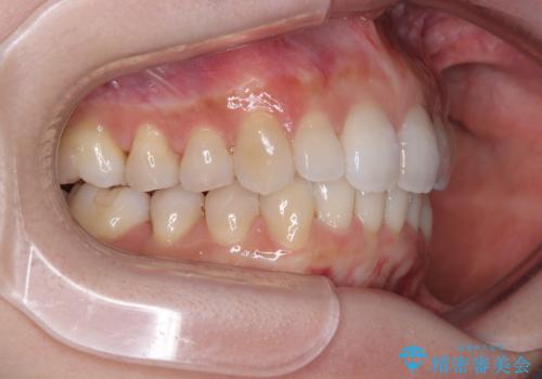 補助装置を用いて奥歯の咬み合わせを事前に改善 インビザラインによる矯正治療の治療後
