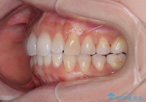 補助装置を用いて奥歯の咬み合わせを事前に改善　インビザラインによる矯正治療の治療後