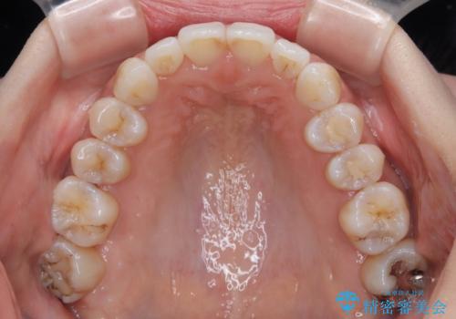 補助装置を用いて奥歯の咬み合わせを事前に改善 インビザラインによる矯正治療の治療後