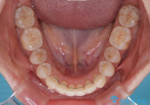 補助装置を用いて奥歯の咬み合わせを事前に改善 インビザラインによる矯正治療の治療後