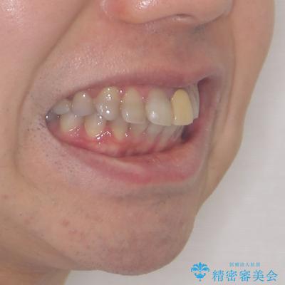 突出した前歯を引っ込める ワイヤー装置での抜歯矯正の治療前(顔貌)