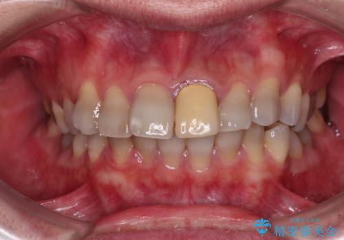 突出した前歯を引っ込める　ワイヤー装置での抜歯矯正の症例 治療前