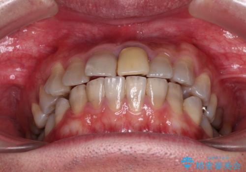 突出した前歯を引っ込める ワイヤー装置での抜歯矯正の治療前