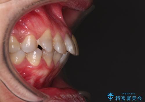 突出した前歯を引っ込める ワイヤー装置での抜歯矯正の治療前