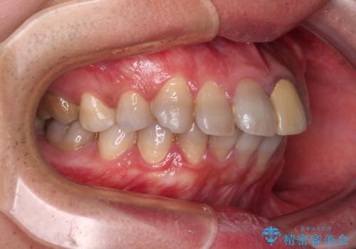 突出した前歯を引っ込める　ワイヤー装置での抜歯矯正の治療前