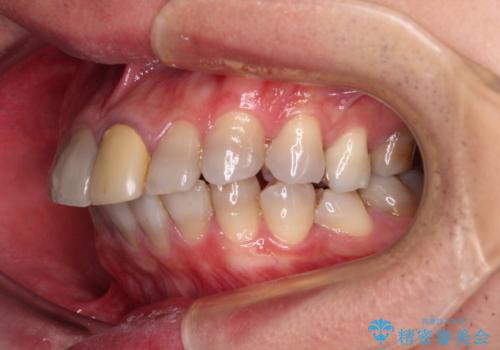 突出した前歯を引っ込める ワイヤー装置での抜歯矯正の治療前