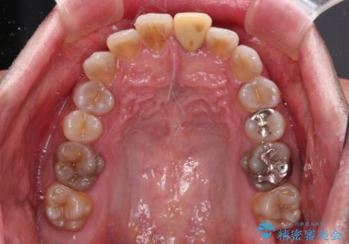 突出した前歯を引っ込める　ワイヤー装置での抜歯矯正の治療前
