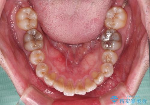 突出した前歯を引っ込める ワイヤー装置での抜歯矯正の治療前