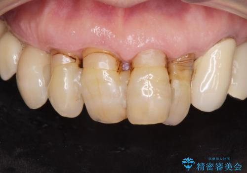 前歯がグラグラする。の症例 治療前