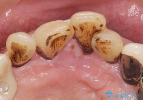 前歯がグラグラする。の治療前