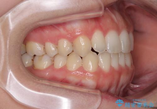 【モニター】オープンバイトをインビザライン矯正で治すの治療後