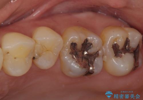 歯に穴があいてフロスが引っかかる　セラミックインレー修復の治療前