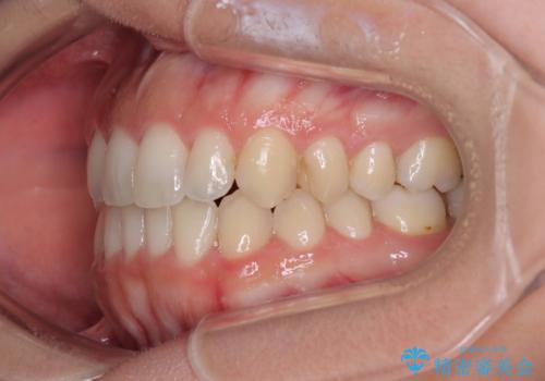 【モニター】オープンバイトをインビザライン矯正で治すの治療後